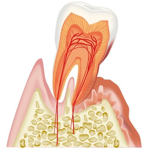 歯周病の治療について